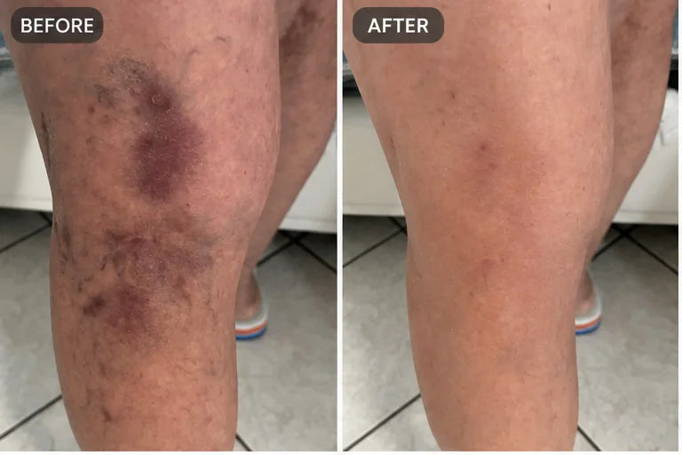 Bruise cream result 1