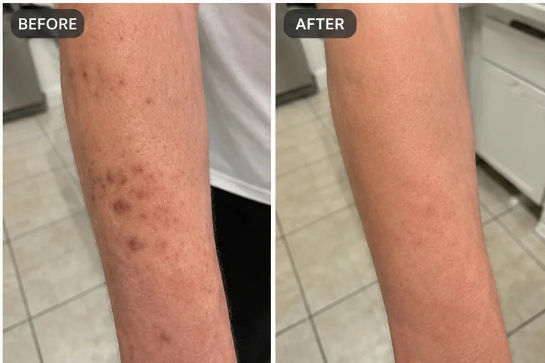 Bruise cream result 6