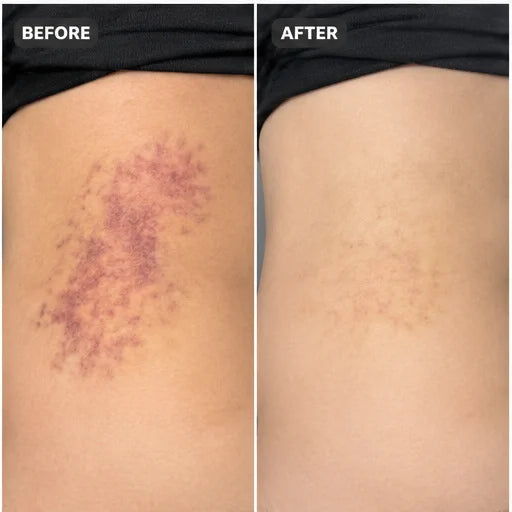 Bruise cream result 2