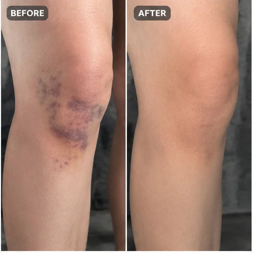 Bruise cream result 5