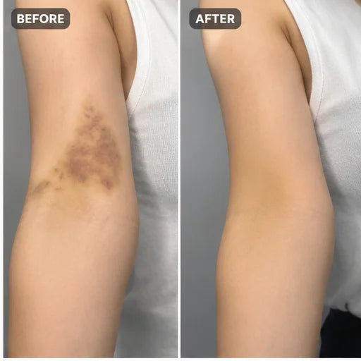 Bruise cream result 3